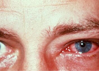 Conjuntivitis: qué es y qué relación tiene con el Covid-19