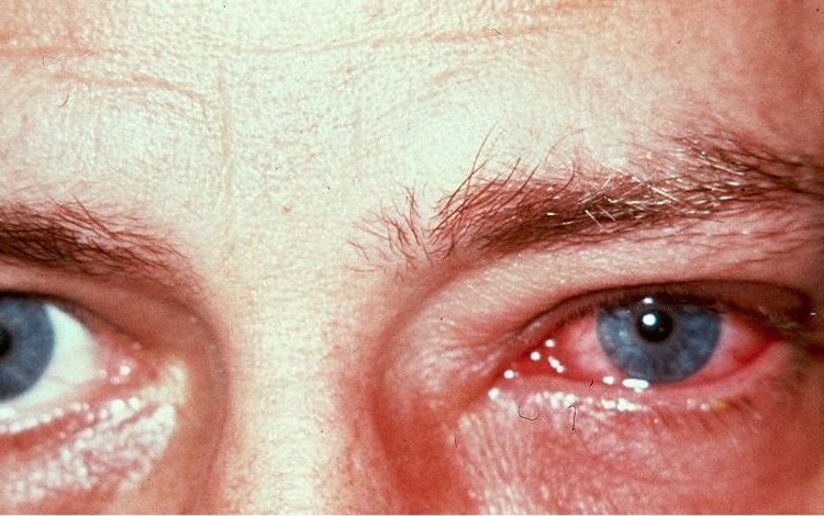 Conjuntivitis: qué es y qué relación tiene con el Covid-19