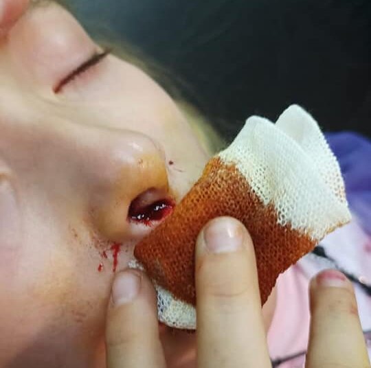 Una niña fue mordida por un perro y recibió cinco puntos en su carita