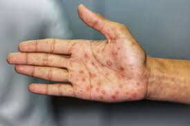 Sífilis: la clave para evitar el contagio es el uso de métodos de barrera